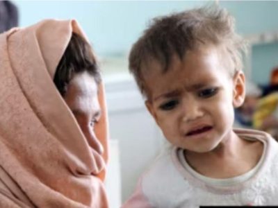 یونیسف: امسال۳۴۳ هزار کودک مبتلا به سوء تغذیه افغان را بستری کردیم