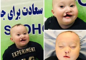 درمان رایگان کودکان لب‌چاک و کام‌چاک در کندز 